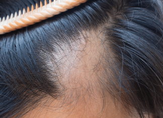 Stiati ca anxietatea provoaca alopecie?