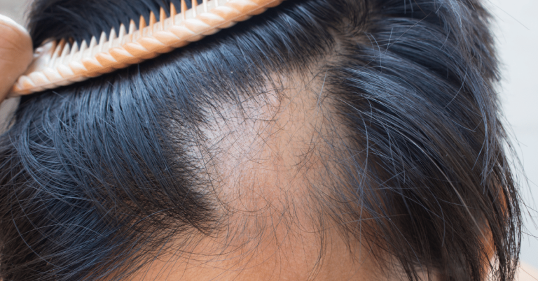 alopecie.jpg