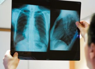 Ce este osteosarcomul?