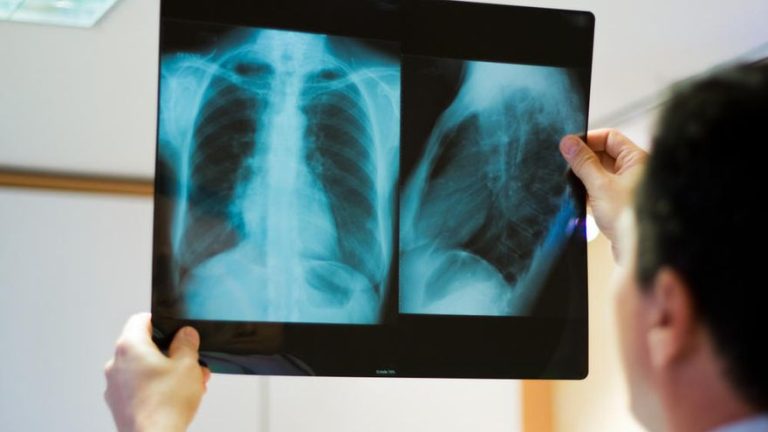 ce-este-osteosarcomul.jpg