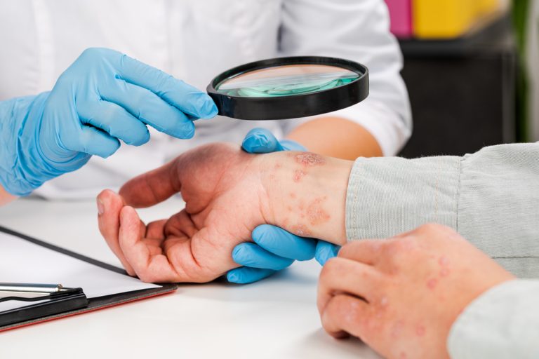 ameliorarea-dermatitei-atopice.jpg