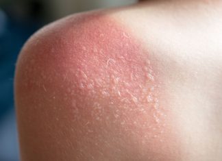 Remedii naturiste eficiente pentru a trata arsurile solare