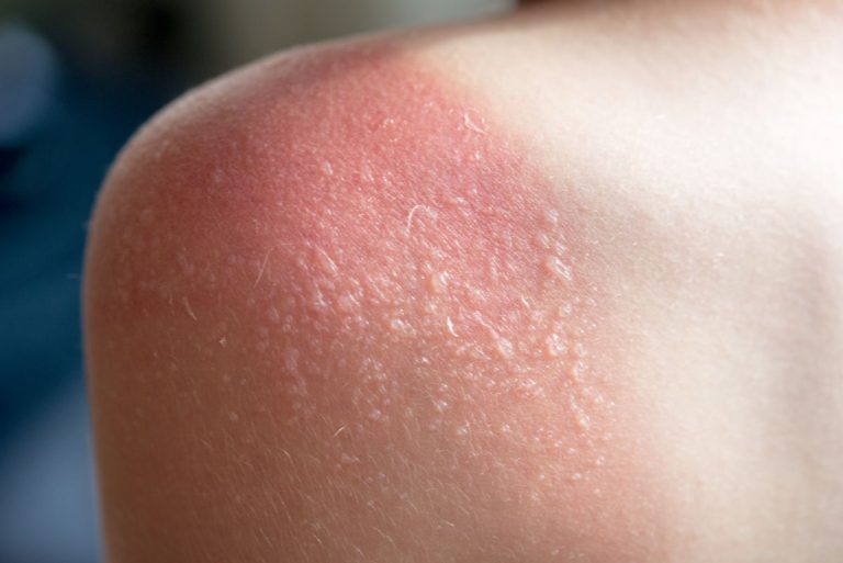 remedii-naturiste-arsuri-solare.jpg